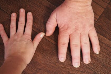 акромегалія